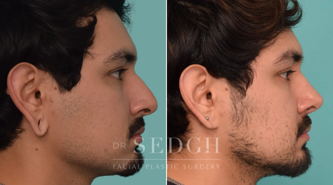 Patient 228 after Ear Lobe Repair, view 2