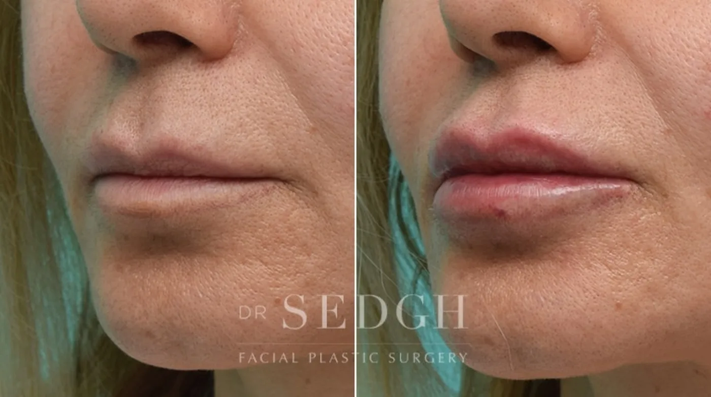 Patient 3 before lip augmentation, view 1
