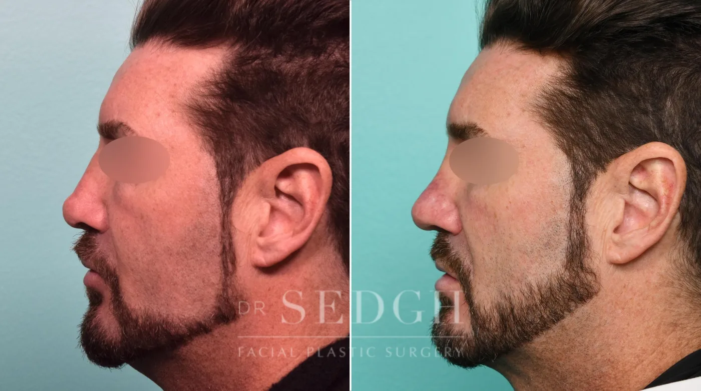 Patient 309 after Neck Liposuction, view 2