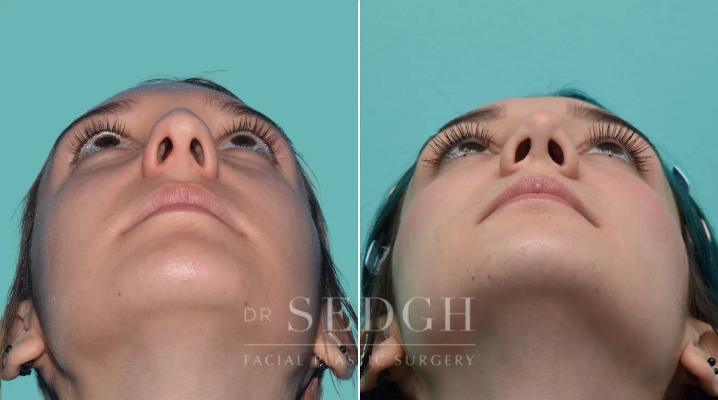 Patient 32 after Rhinoplasty, view 3