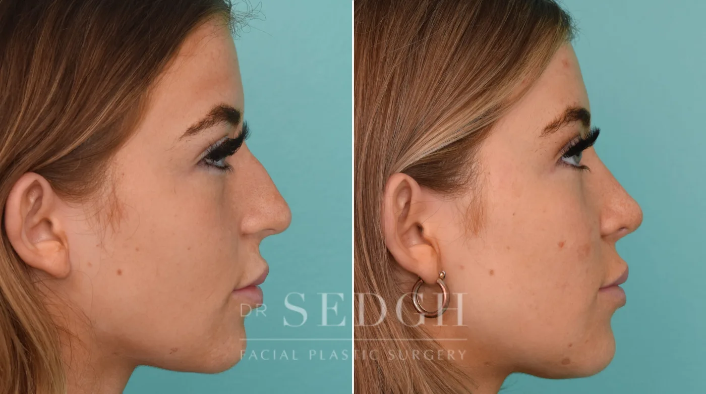 Patient 242 after Rhinoplasty, view 1